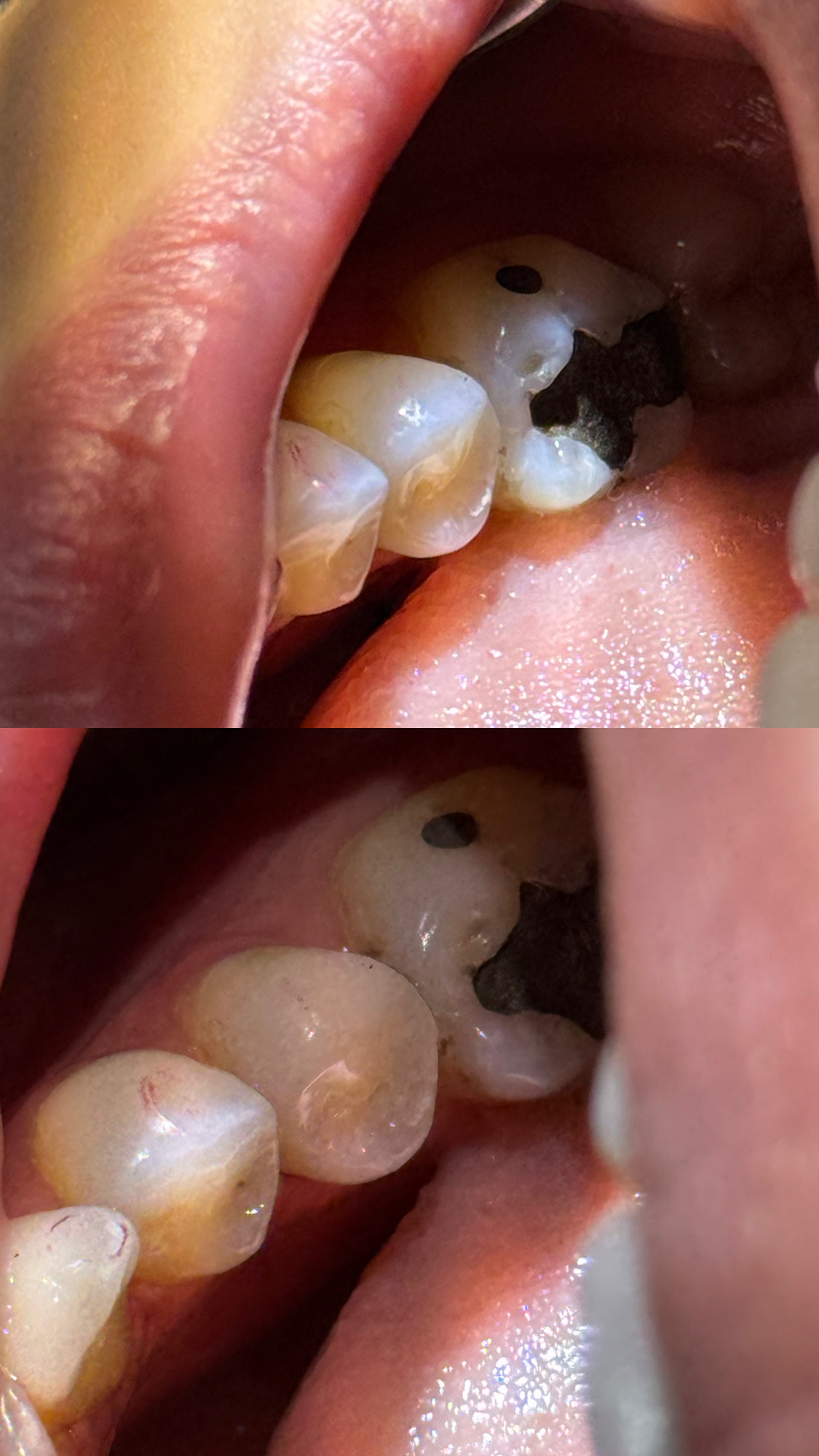 🦷 ترمیم دندان با ظاهری کاملاً طبیعی ✨
