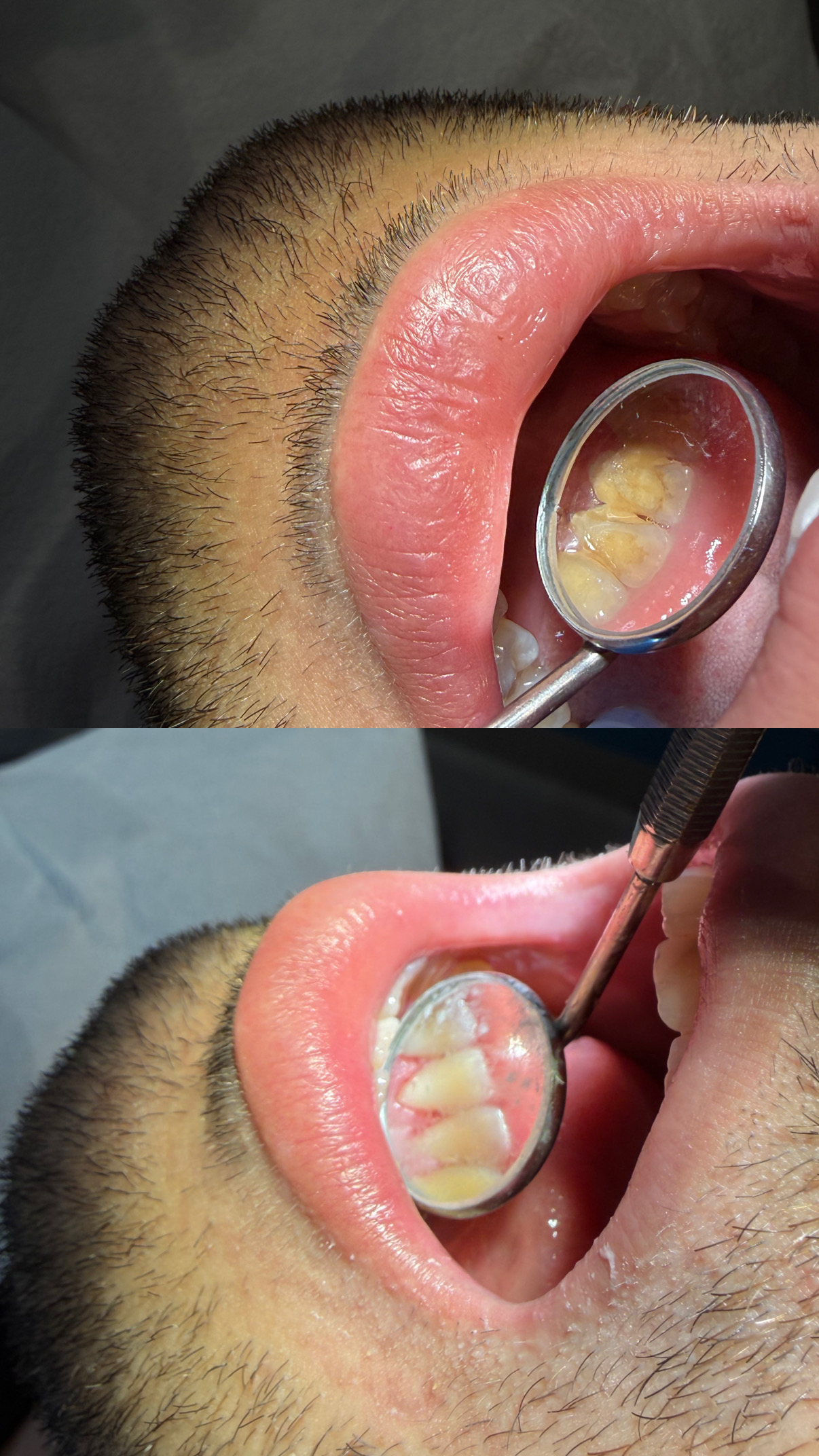 🦷 جرم‌گیری دندان؛ بدون آسیب به مینای دن