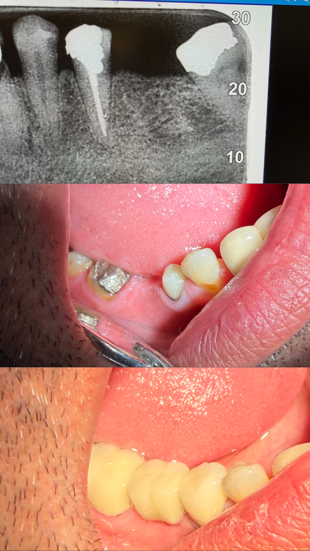 🦷 بریج دندانی؛ جایگزینی اصولی دندان‌های