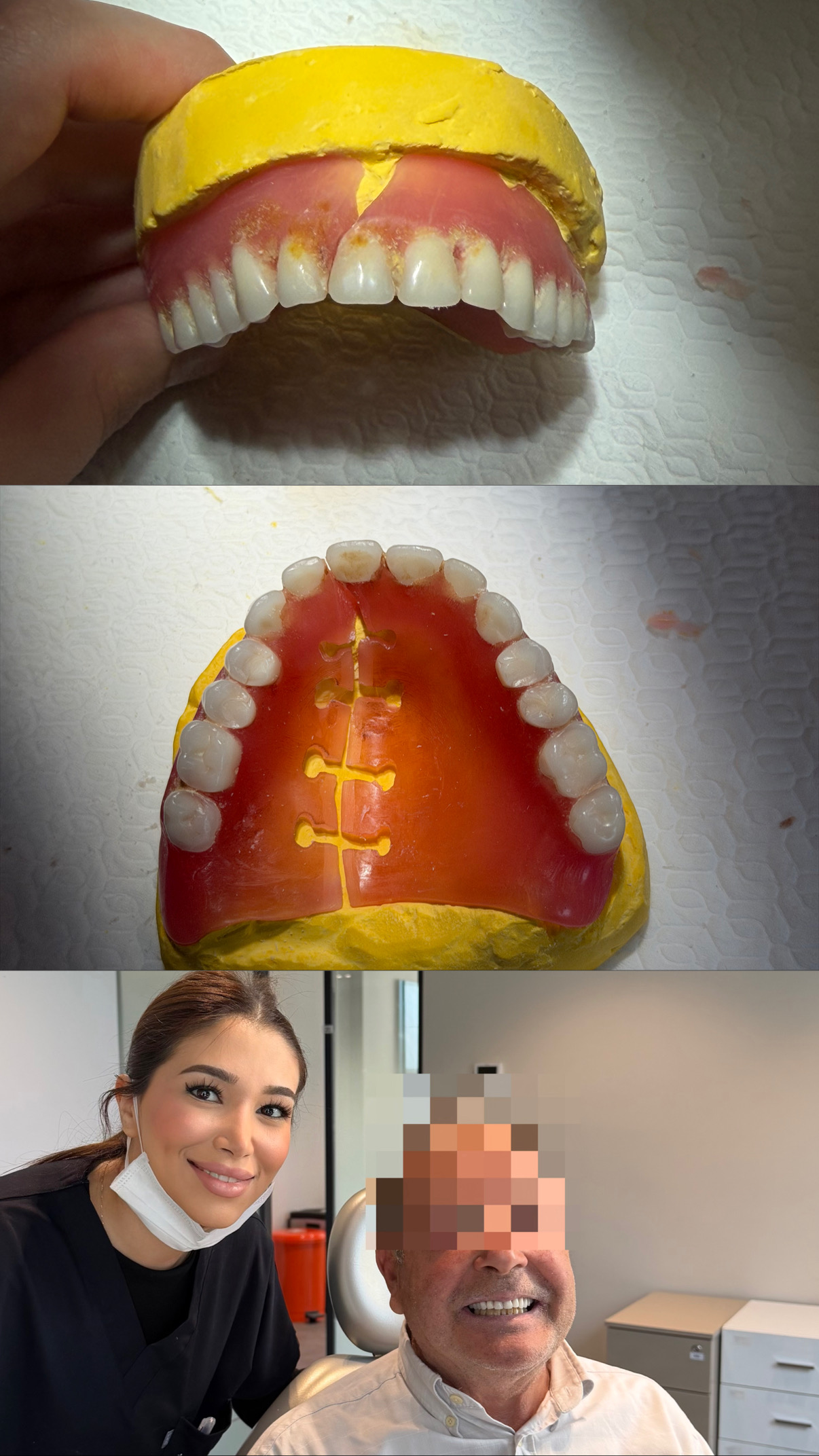 🦷 ترمیم پروتز دندانی در مواقع شکستگی یا